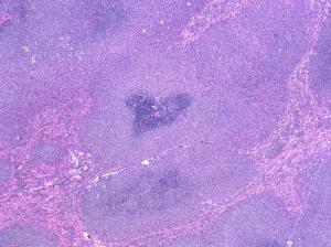 Mantle Cell lenfoma
